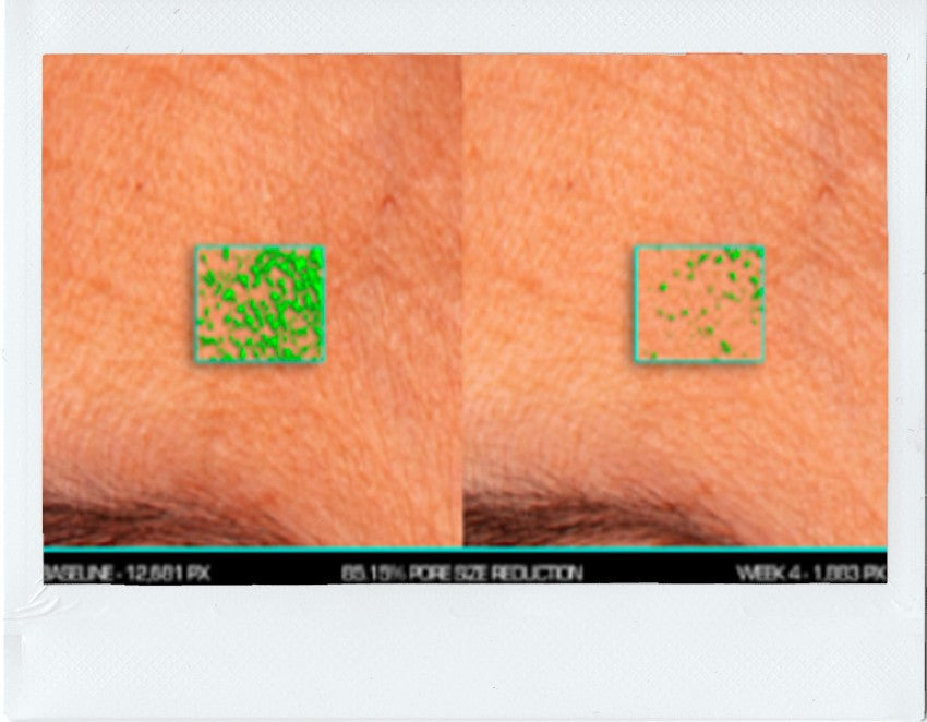 Forehead area: Pore size improvement