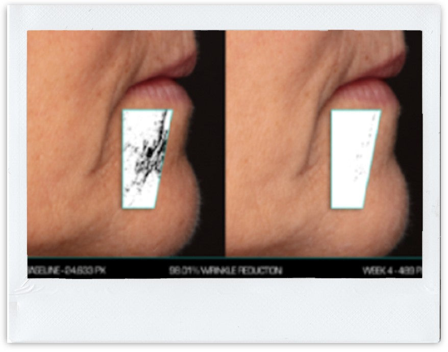 Chin area: Wrinkle Improvement